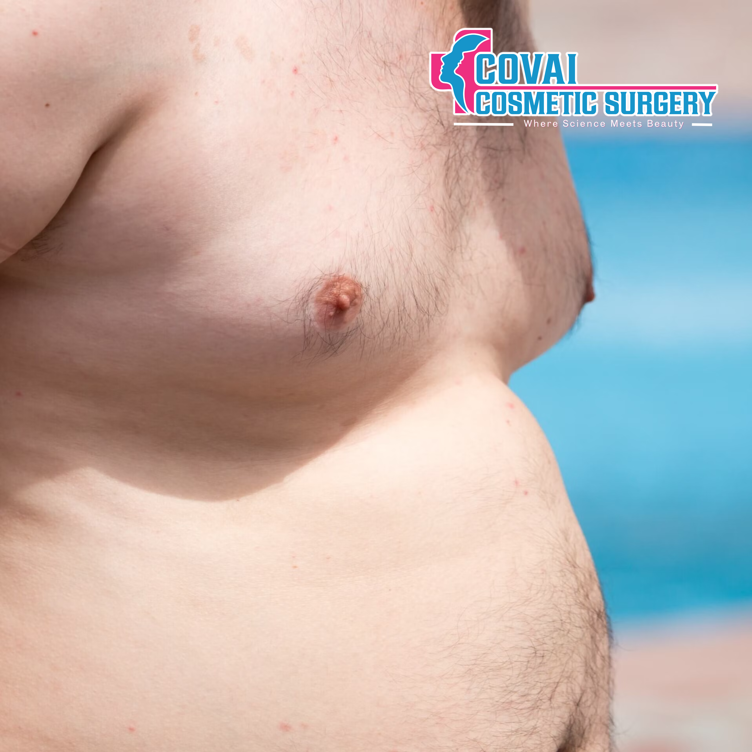 Chest Fat Adipomastia
